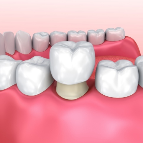 Animated smile during dental crown placement