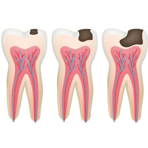 Animated tooth showing how decay may lead to a pulpotomy
