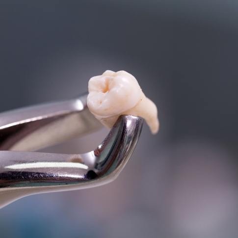 Metal clasp holding an extracted tooth