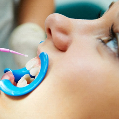 Worcester pediatric dentist applying dental sealants to child's teeth