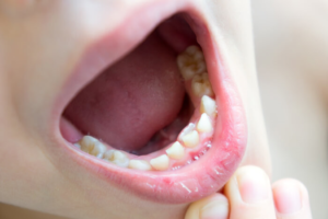 a closeup of a child with shark teeth